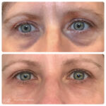 Usunięcie cieni pod oczami