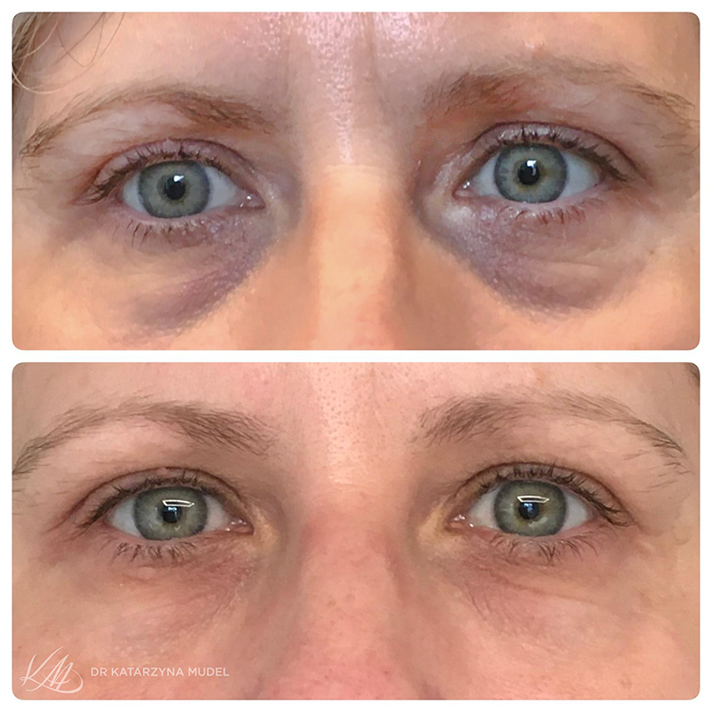 Usunięcie cieni pod oczami