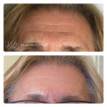 Poprawa wyglądu czoła