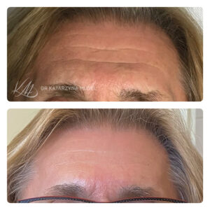 Poprawa wyglądu czoła