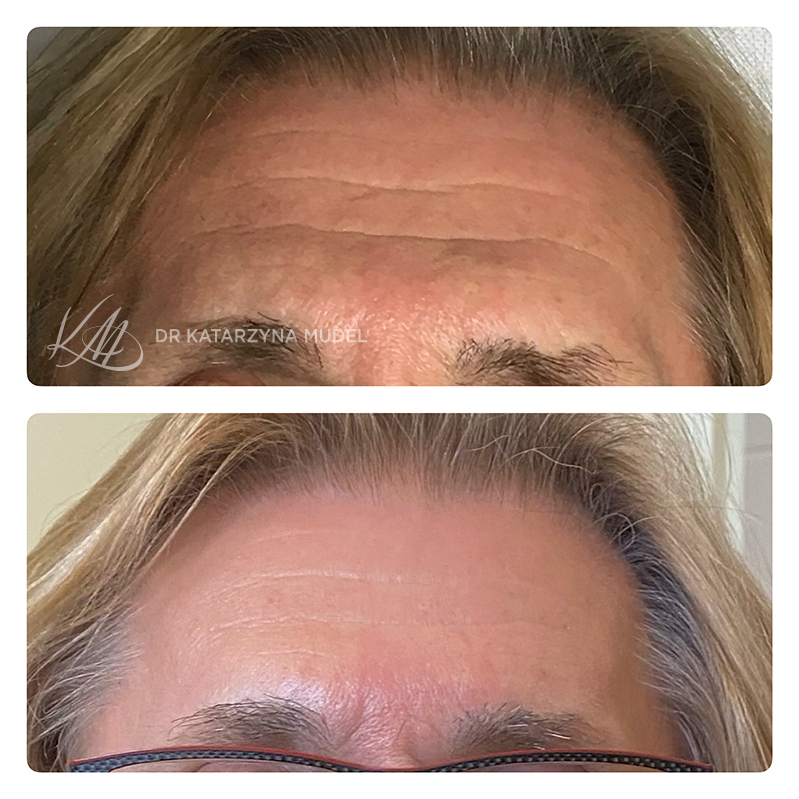 Poprawa wyglądu czoła