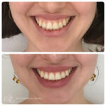 Modelowanie uśmiechu dziąsłowego