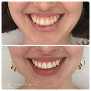 Modelowanie uśmiechu dziąsłowego