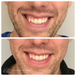 Modelowanie uśmiechu dziąsłowego