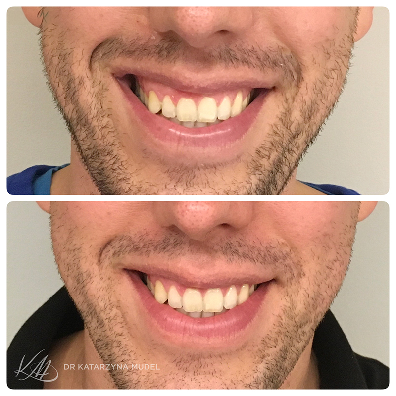 Modelowanie uśmiechu dziąsłowego