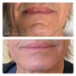 Poprawa wyglądu brody