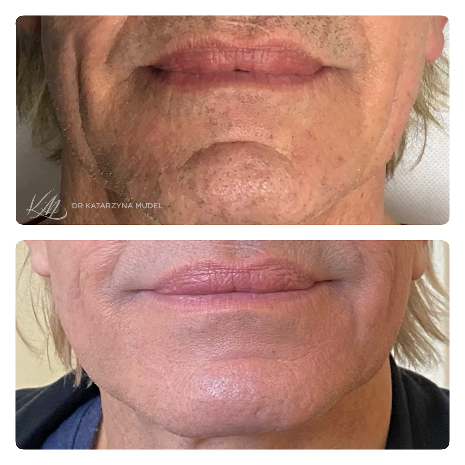 Poprawa wyglądu brody